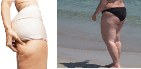 Cellulite in overweight woman as well as on the skinny.